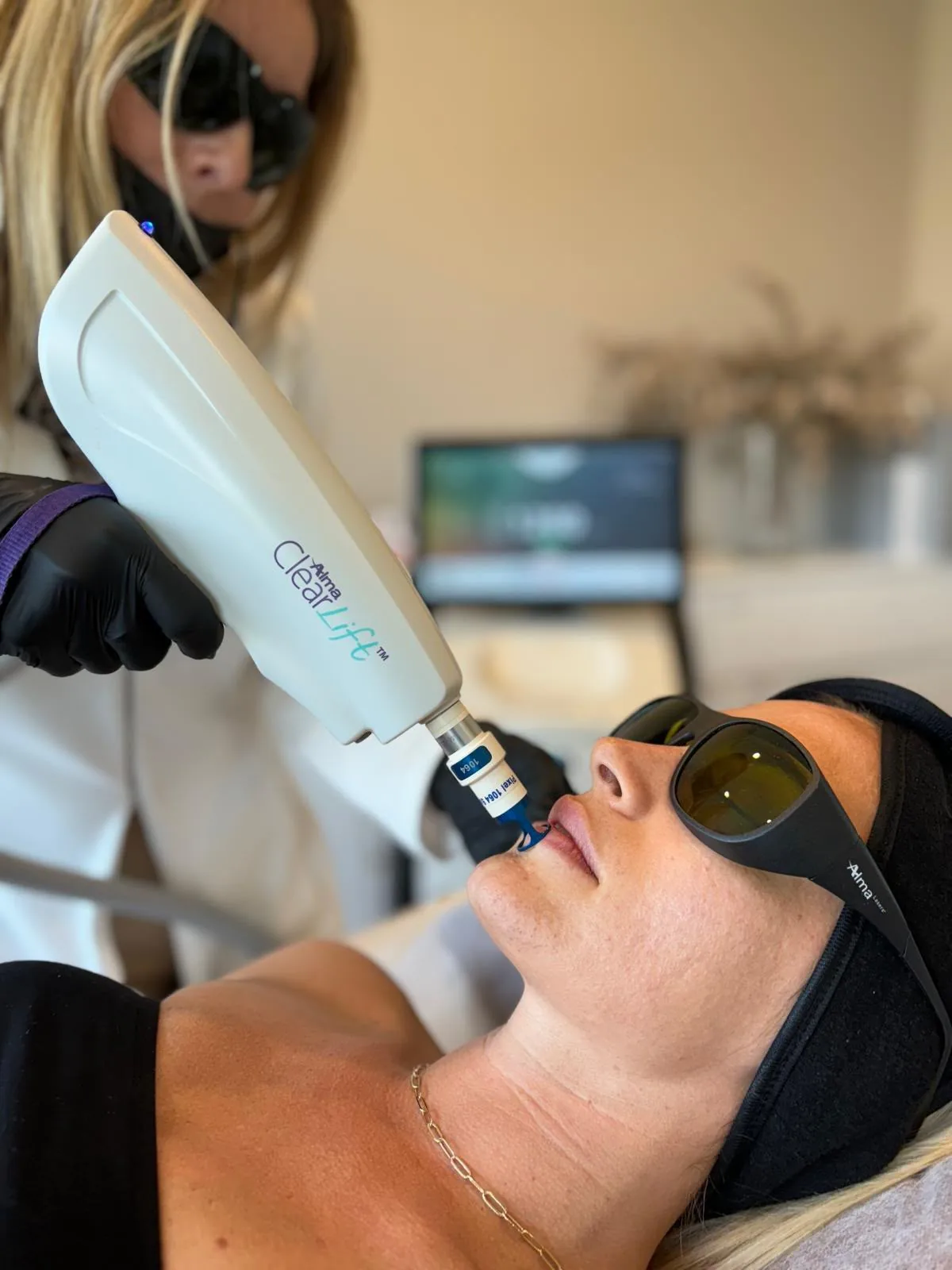 Médica con bata blanca aplica el cabezal ClearLift sobre el labio superior de una paciente con gafas de protección láser