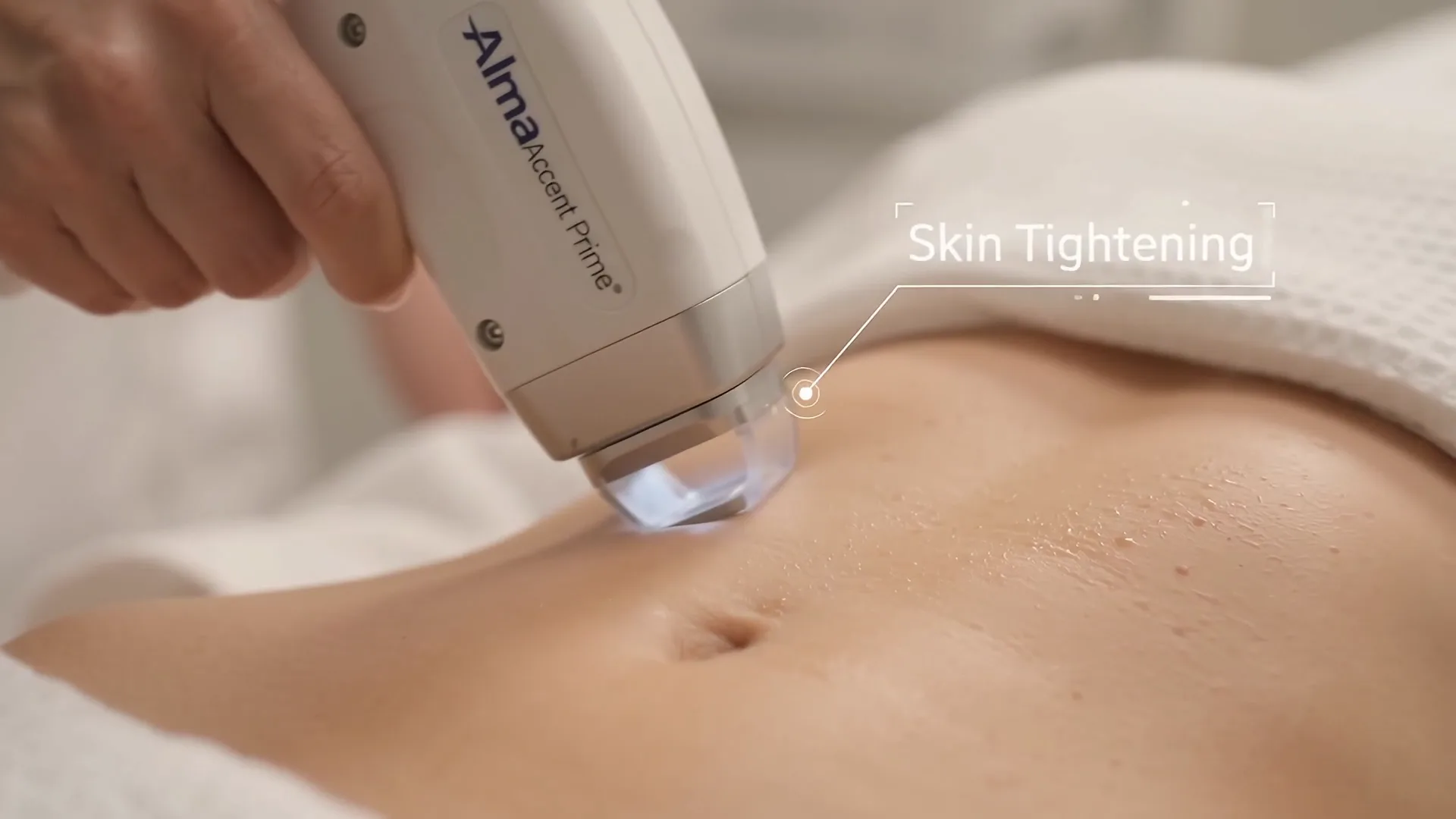 Accent Prime sobre el abdomen · Vídeo generado