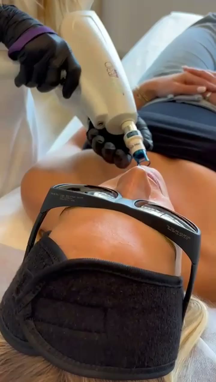 Vídeo en primer plano del cabezal ClearLift desplazándose por el labio y el mentón de una paciente con gafas de protección